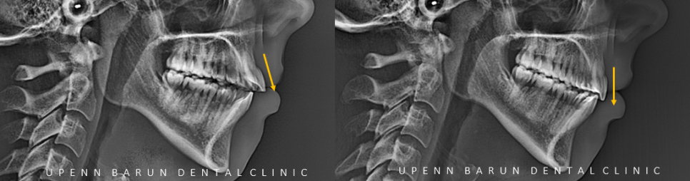 개방교합은 교정용 미니스크류 쓰지말고 인비절라인만으로 쉽게 해결하세요! (잠실인비절라인  잠실새내인비절라인  개방교합교정  잠실새내교정치과) 관련 이미지 15