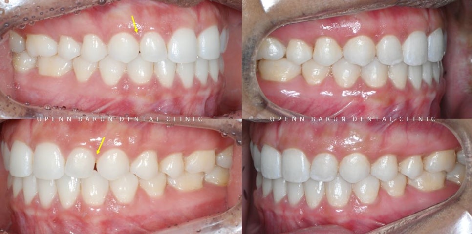 앞니벌어짐 인비절라인익스프레스로 해결하기 (인비절라인앞니부분교정 인비절라인재교정 송파인비절라인 잠실인비절라인 잠실교정치과 인비절라인익스프레스비용) 관련 이미지 15
