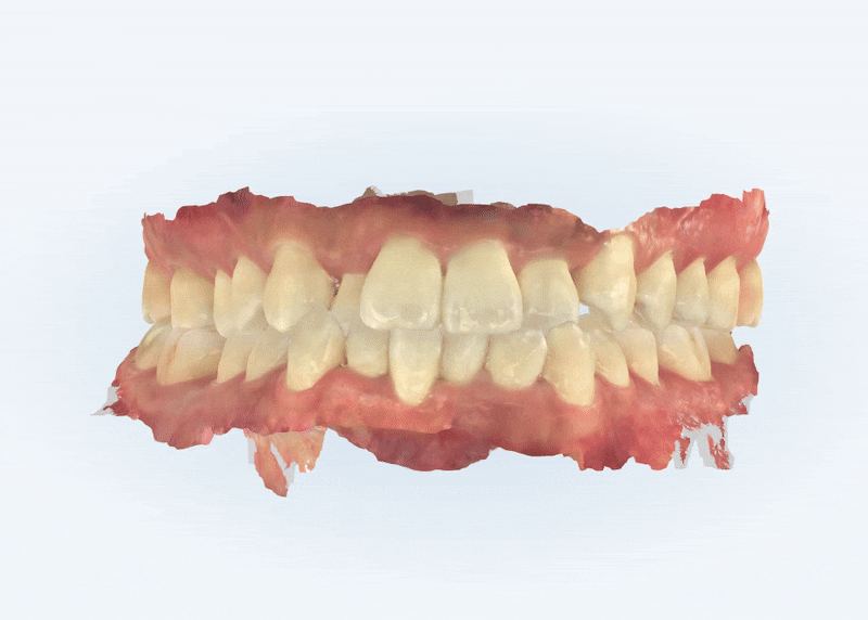 송파인비절라인다이아몬드등급 치과에서 악궁확장장치 없이 반대교합 해결한 후기(인비절라인높은등급 인비절라인반대교합 인비절라인비발치교정 인비절라인잘하는치과 인비절라인교정전문) 관련 이미지 3