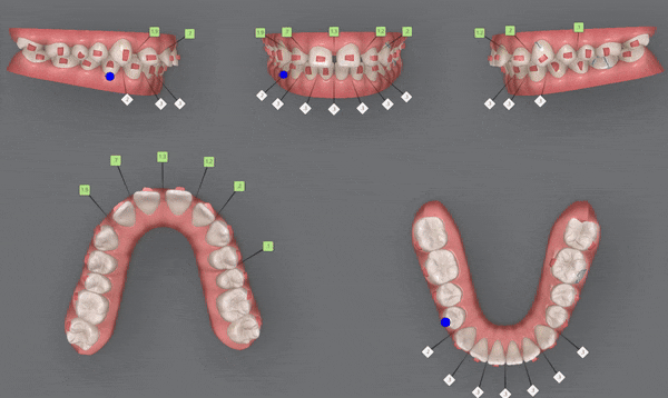 잠실인비절라인등급 잠실부분교정 앞니틈교정 인비절라인라이트 옵션으로 빠르게 해결한 후기 (삼성역부분교정 인비절라인앞니재교정 잠실역교정치과 삼전동인비절라인 삼전동교정치과) 관련 이미지 8