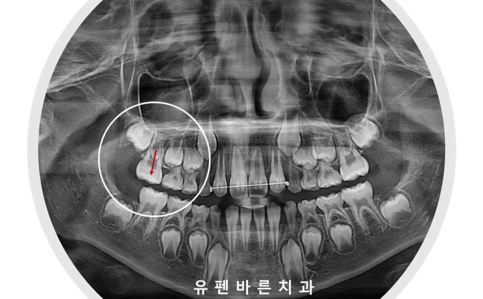 아이가 반대교합(주걱턱)인데 1차교정을 꼭해야 하나요? 관련 이미지 7