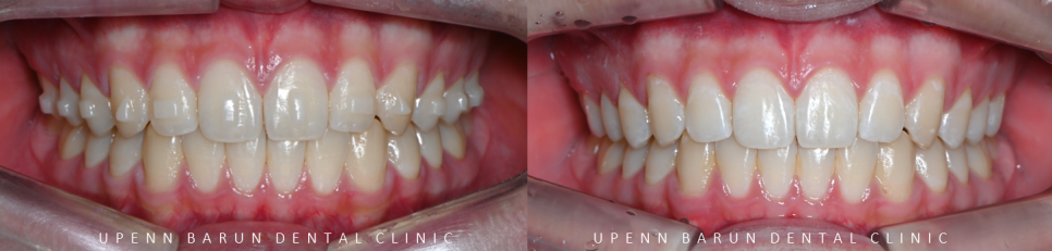 인비절라인다이아몬드등급치과에서 7주만에 앞니벌어짐 고민 해결한 후기(인비절라인앞니교정 인비절라인익스프레스 잠실인비절라인 인비절라인앞니교정후기) 관련 이미지 9