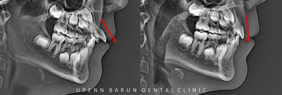 유독 튀어나와 다치기 쉬운 앞니! INVISALIGN FIRST로 8개월만에 끝낸 후기 (송파인비절라인소아교정 인비절라인1차교정 송파인비절라인퍼스트  송파인비절라인어린이교정) 관련 이미지 16