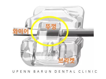 유학생치아교정 유학생교정치과 잠실교정치과 잠실데이몬교정 데이몬클리어교정 Wide Smile (송파교정치과 잠실새내교정치과 강동교정치과 헬리오시티교정치과 예쁜미소 Smile Arc) 관련 이미지 9