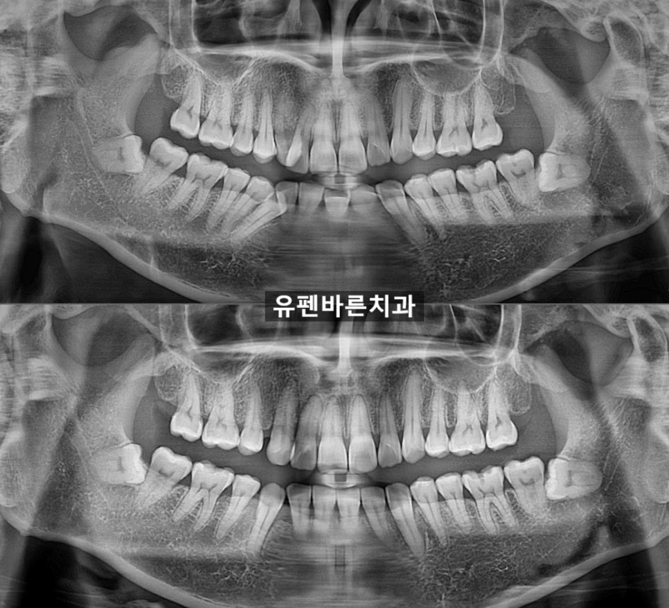 해외거주 중인데 발치교정도 인비절라인으로 가능한가요? 관련 이미지 11