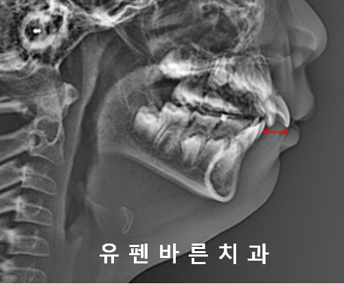 우리아이, 무턱교정 해야할까요? 관련 이미지 2