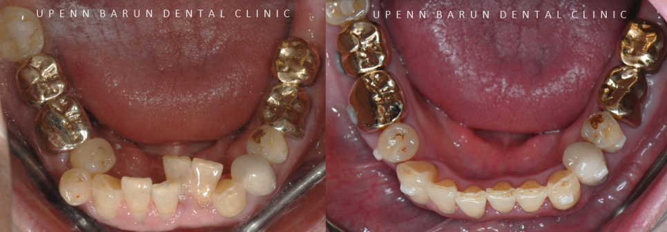 평생 삐뚤어진 치아가 고민이셨던 79세 고령환자분이 선택한 송파인비절라인다이아몬드등급 후기 (서울인비절라인전문치과 잠실인비절라인교정치과 노인교정 노인치아교정 노인교정치과) 관련 이미지 11