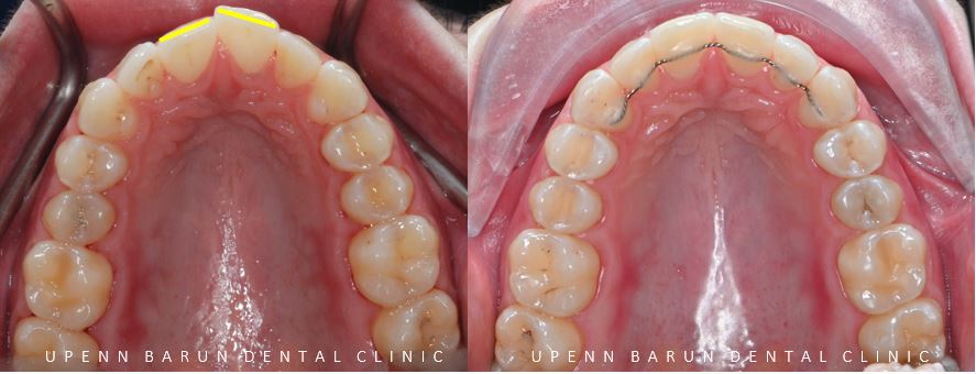 잠실교정치과 유펜바른치과의 인비절라인익스프레스가 특별한 이유 (5개월 인비절라인급속교정 잠실인비절라인 송파인비절라인 인비절라앞니부분교정) 관련 이미지 6