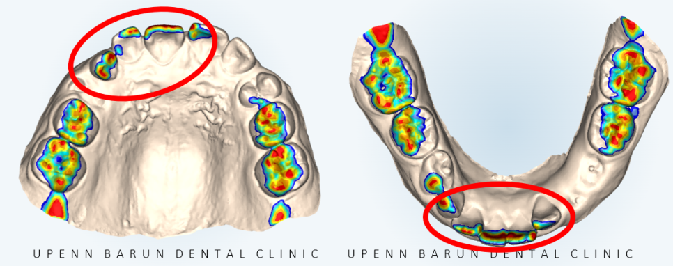 다이아몬드등급치과에서 인비절라인퍼스트로 반대교합 해결! 1차, 2차교정을 한번에!( 어린이반대교합 송파인비절라인퍼스트 잠실엘스상가교정치과 잠실인비절라인퍼스트 인비절라인스피커치과) 관련 이미지 7
