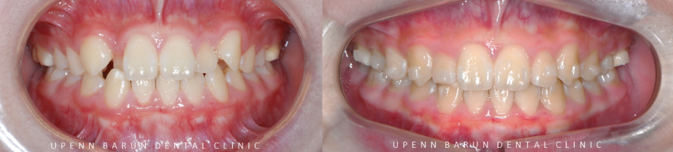 2024년 송파구 단일 치과의원급 중 유일!!! 인비절라인다이아몬드등급 달성한 유펜바른치과의 청소년인비절라인 후기 (청소년반대교합 어린이반대교합 잠실인비절라인잘하는치과) 관련 이미지 11