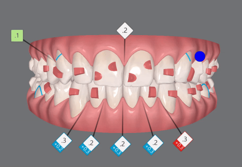 '옥니같이 보여요' 인비절라인급속교정 가능할까? with 캐리에모션장치 (잠실다이아몬드등급 인비절라인다이아몬드등급 서울다이아몬드등급치과 옥니인비절라인후기) 관련 이미지 11