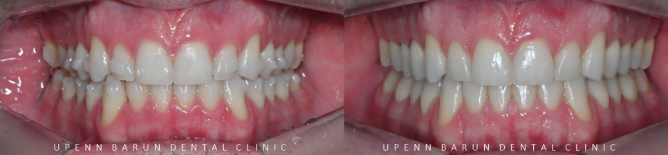 인비절라인다이아몬드등급치과에서 28개의 교정장치로 고민 해결한 후기가 궁금하다면? (잠실송곳니덧니교정 잠실인비절라인 인비절라인교정기간 투명교정장치후기 잠실인비절라인후기) 관련 이미지 10