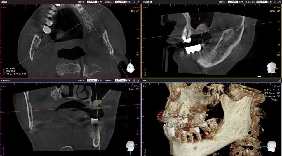 상악동 때문에 대학병원가서 임플란트 하라고 권유받으신 분들 필독!!! 관련 이미지 5