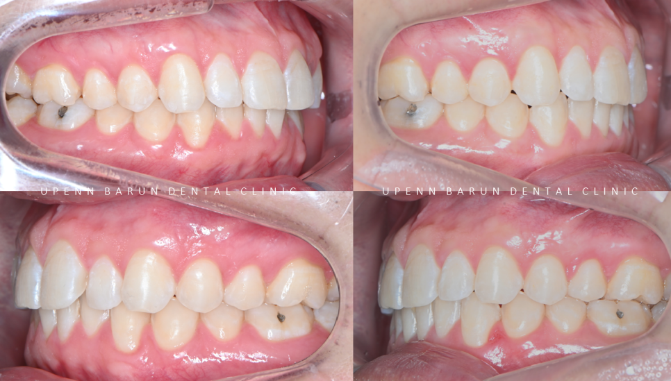 인비절라인을 시작할때 고려해야 하는 세가지 조건 (인비절라인다이아몬드 다이아몬드등급치과 인비절라인앞니교정 앞니급속교정 비발치교정 치간삭제 치간삭제양) 관련 이미지 16