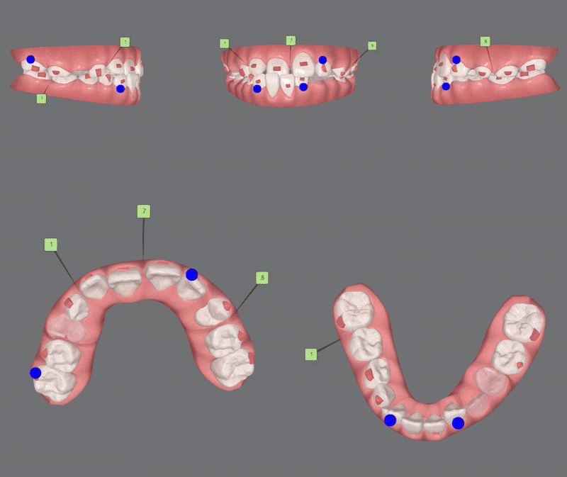 다이아몬드등급치과에서 인비절라인퍼스트로 반대교합 해결! 1차, 2차교정을 한번에!( 어린이반대교합 송파인비절라인퍼스트 잠실엘스상가교정치과 잠실인비절라인퍼스트 인비절라인스피커치과) 관련 이미지 11