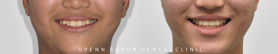 비발치교정 성장기교정 청소년치아교정은 잠실교정치과 유펜바른치과에서 관련 이미지 2