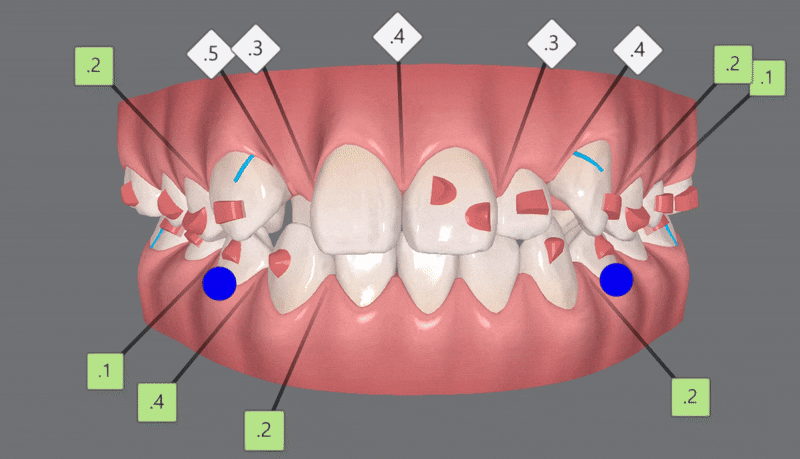 2024년 송파구 단일 치과의원급 중 유일!!! 인비절라인다이아몬드등급 달성한 유펜바른치과의 청소년인비절라인 후기 (청소년반대교합 어린이반대교합 잠실인비절라인잘하는치과) 관련 이미지 9