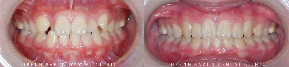 2024년 송파구 단일 치과의원급 중 유일!!! 인비절라인다이아몬드등급 달성한 유펜바른치과의 청소년인비절라인 후기 (청소년반대교합 어린이반대교합 잠실인비절라인잘하는치과) 관련 이미지 17