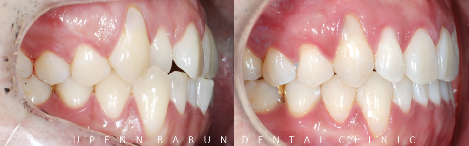 잠실덧니교정 인비절라인으로 컴플렉스 해결! (비발치교정 인비절라인등급 인비절라인후기 ) 관련 이미지 10