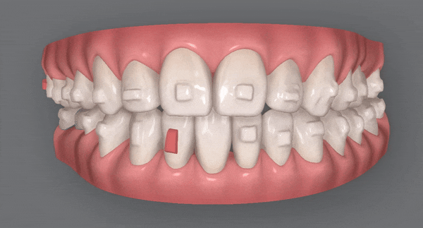 인비절라인 공식 스피커가 상주하고 치료하는 송파교정잘하는치과 유펜바른치과 (잠실성인교정 잠실재교정 잠실인비절라인 성인인비절라인교정 잠실나루역교정치과 문정동교정치과 삼전역교정치과) 관련 이미지 12