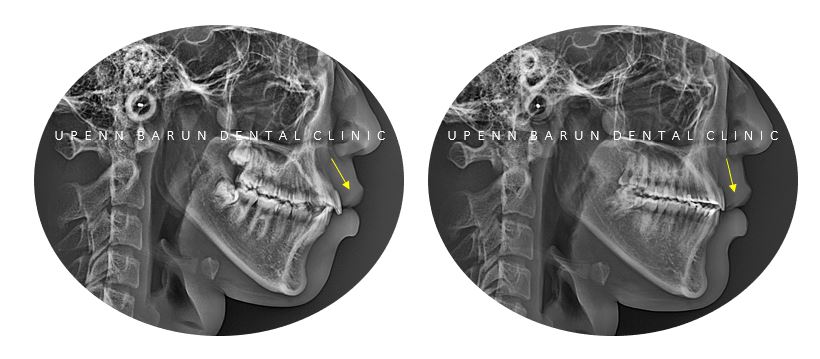 잠실청소년교정 청소년소년돌출입교정 잠실발치교정은 유펜바른치과에서! (잠실나루역교정치과 삼전역교정치과 잠실새내교정치과 돌출입전후 발치교정전후사진) 관련 이미지 8