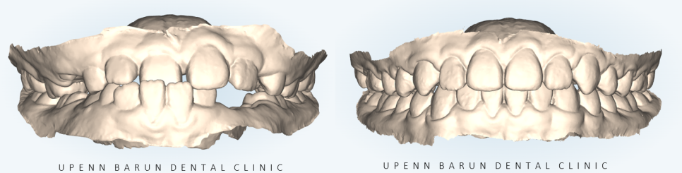 다이아몬드등급치과에서 인비절라인퍼스트로 반대교합 해결! 1차, 2차교정을 한번에!( 어린이반대교합 송파인비절라인퍼스트 잠실엘스상가교정치과 잠실인비절라인퍼스트 인비절라인스피커치과) 관련 이미지 5