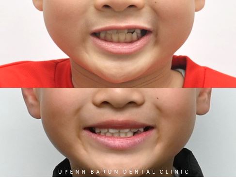 8세 어린이반대교합 인비절라인퍼스트로 수월하게 해결 후기! 잠실인비절라인퍼스트 잠실인비절라인소아교정 (잠실교정치과 잠실인비절라인 인비절라인등급 인비절라인후기 잠실소아교정) 관련 이미지 19