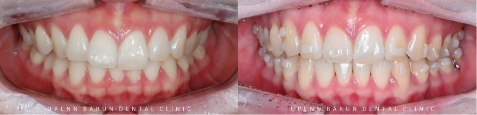 앞니부분교정 인비절라인라이트로 해결하기 (잠실인비절라인치과 송파인비절라인치과 잠실새내인비절라인치과 강동인비절라인치과 헬리오시티인비절라인 송파역인비절라인 석촌역인비절라인) 관련 이미지 10