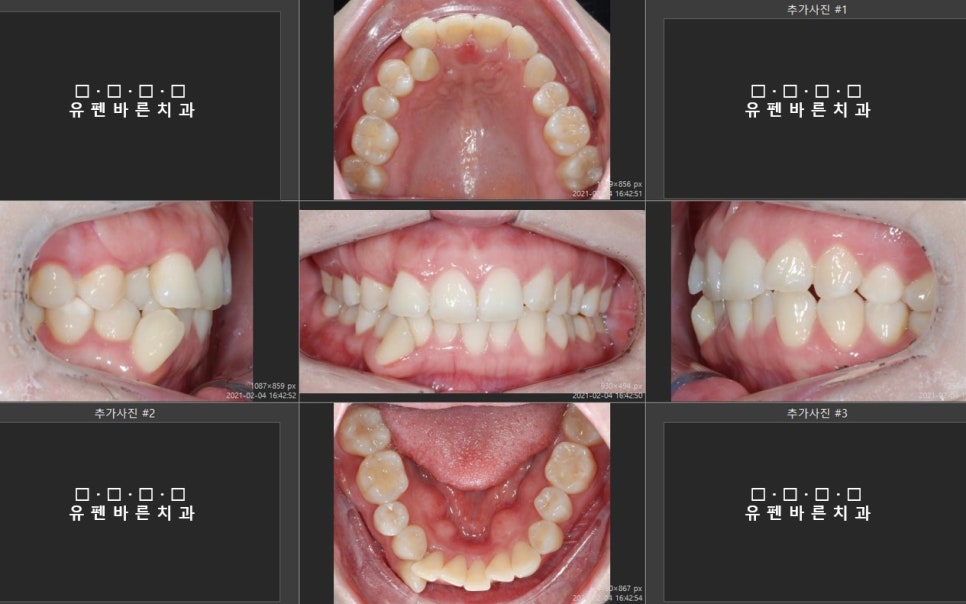 해외거주 중인데 발치교정도 인비절라인으로 가능한가요? 관련 이미지 1