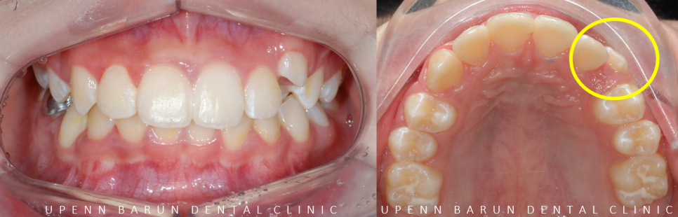 잠실소아인비절라인 잠실어린이인비절라인 송파인비절라인 잠실인비절라인후기 (잠실새내교정치과 엘스상가교정치과 파인애플상가교정치과 잠실새내역인비절라인 청소년교정후기 잠실인비절라인퍼스트) 관련 이미지 3