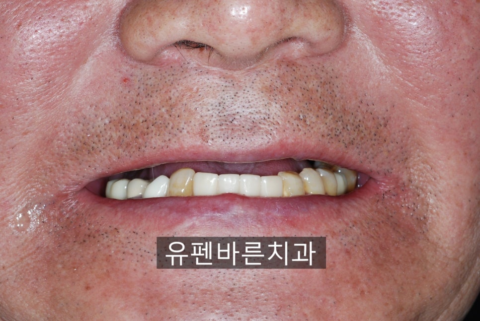 해보니까 임플란트가 편해요!!! 관련 이미지 2