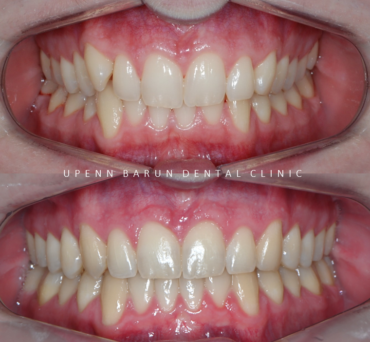 '옥니같이 보여요' 인비절라인급속교정 가능할까? with 캐리에모션장치 (잠실다이아몬드등급 인비절라인다이아몬드등급 서울다이아몬드등급치과 옥니인비절라인후기) 관련 이미지 3