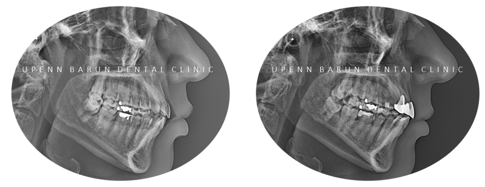 같은원장님께 보철치료와 교정치료를 동시에! 앞니사이 틈 해결한 후기 ( 송파교정치과 잠실교정잘하는치과 송파교정잘하는치과 올림픽파크포레온교정치과 올림픽파크포레온인비절라인치과) 관련 이미지 12