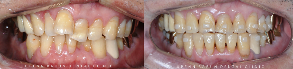 평생 삐뚤어진 치아가 고민이셨던 79세 고령환자분이 선택한 송파인비절라인다이아몬드등급 후기 (서울인비절라인전문치과 잠실인비절라인교정치과 노인교정 노인치아교정 노인교정치과) 관련 이미지 10