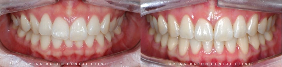 앞니부분교정 인비절라인라이트로 해결하기 (잠실인비절라인치과 송파인비절라인치과 잠실새내인비절라인치과 강동인비절라인치과 헬리오시티인비절라인 송파역인비절라인 석촌역인비절라인) 관련 이미지 19