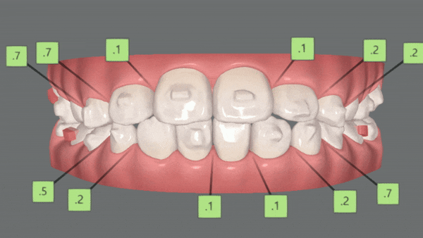 8세 어린이반대교합 인비절라인퍼스트로 수월하게 해결 후기! 잠실인비절라인퍼스트 잠실인비절라인소아교정 (잠실교정치과 잠실인비절라인 인비절라인등급 인비절라인후기 잠실소아교정) 관련 이미지 12