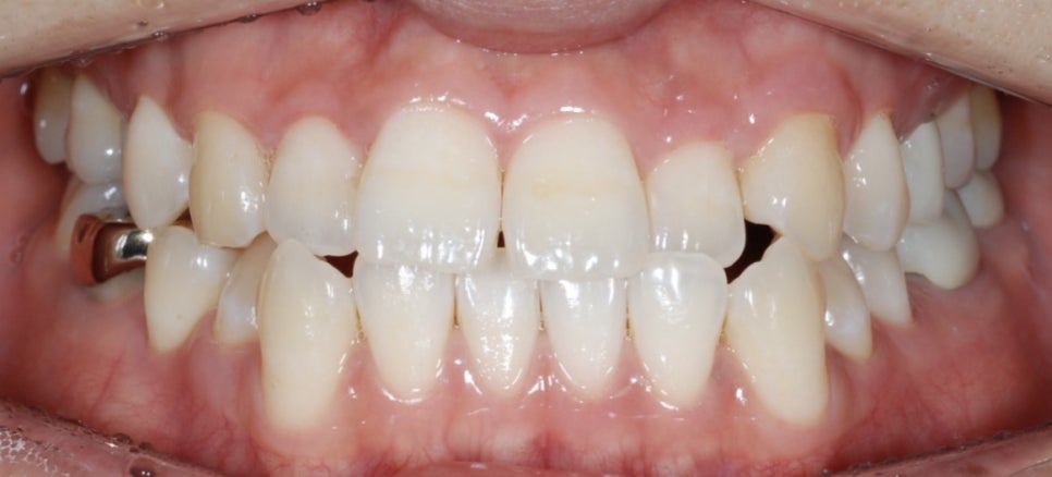 인비절라인의 4가지 종류에 대해 알고 계시나요? 관련 이미지 3