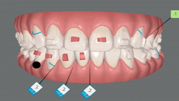 앞니부분교정 인비절라인라이트로 해결하기 (잠실인비절라인치과 송파인비절라인치과 잠실새내인비절라인치과 강동인비절라인치과 헬리오시티인비절라인 송파역인비절라인 석촌역인비절라인) 관련 이미지 11