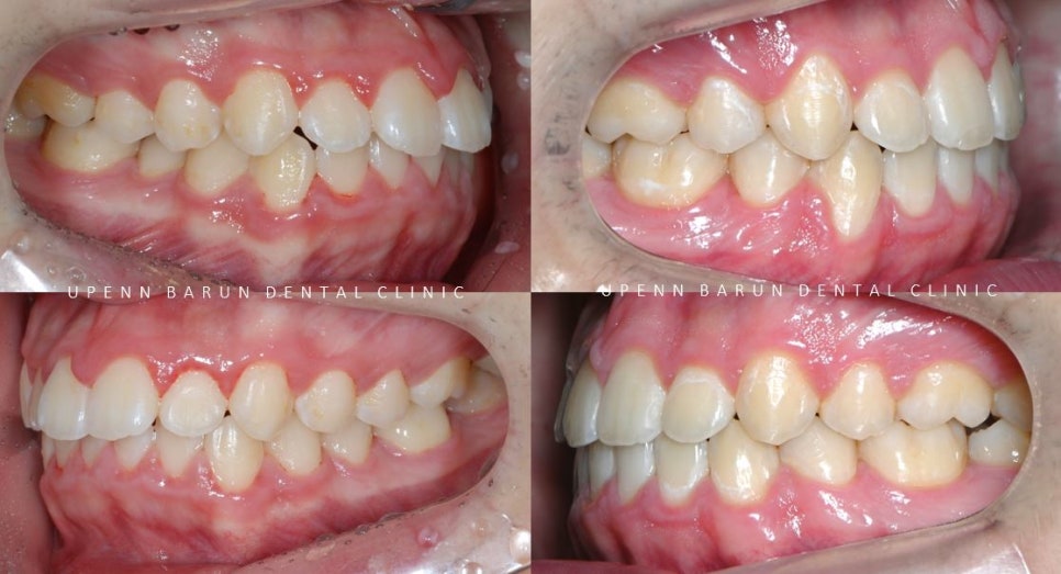 잠실청소년교정 청소년소년돌출입교정 잠실발치교정은 유펜바른치과에서! (잠실나루역교정치과 삼전역교정치과 잠실새내교정치과 돌출입전후 발치교정전후사진) 관련 이미지 9