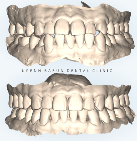 주걱턱 반대교합도 잠실인비절라인 잠실교정치과 유펜바른치과에서!(비발치주걱턱교정 잠실성인교정 반대교합인비절라인 잠실교정치과 주걱턱교정후기) 관련 이미지 23