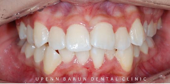 잠실돌출입교정 잠실발치교정 후기가 궁금하다면? (교정후얼굴변화후기 잠실교정치과 돌출입교정후기 돌출입전후사진) 관련 이미지 5