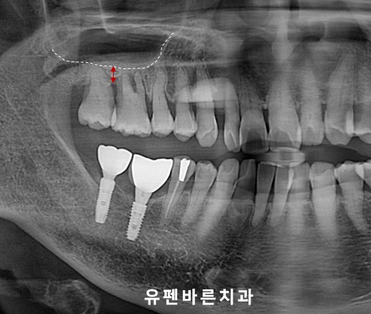 상악동 때문에 대학병원가서 임플란트 하라고 권유받으신 분들 필독!!! 관련 이미지 6