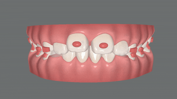 유독 튀어나와 다치기 쉬운 앞니! INVISALIGN FIRST로 8개월만에 끝낸 후기 (송파인비절라인소아교정 인비절라인1차교정 송파인비절라인퍼스트  송파인비절라인어린이교정) 관련 이미지 10