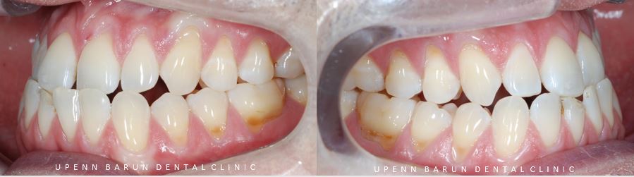 ABO 미국 치과교정과 전문의의 비수술치아교정 악궁확장장치 후기 (잠실교정전후 잠실새내교정치과 잠실교정치과 교정통증  앞니 변화) 관련 이미지 8