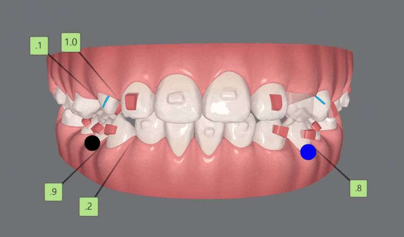 다이아몬드등급치과에서 인비절라인퍼스트로 반대교합 해결! 1차, 2차교정을 한번에!( 어린이반대교합 송파인비절라인퍼스트 잠실엘스상가교정치과 잠실인비절라인퍼스트 인비절라인스피커치과) 관련 이미지 14