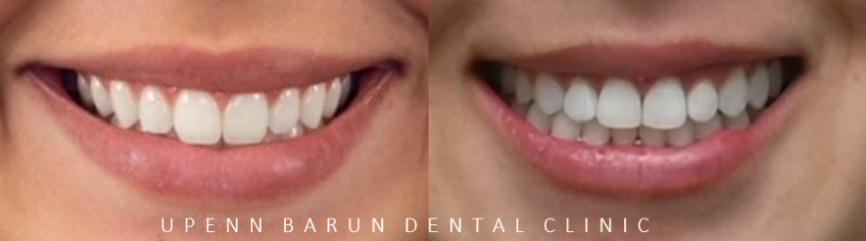 잇몸웃음 거미스마일(gummy smile) 교정후 입동굴 예쁜미소로!(잠실교정치과 거미스마일교정후기 거미스마일교정전후 클라리티세라믹교정 미니스크류교정 미국치과교정과전문의) 관련 이미지 13