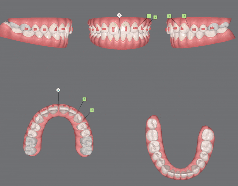인비절라인다이아몬드등급치과에서 7주만에 앞니벌어짐 고민 해결한 후기(인비절라인앞니교정 인비절라인익스프레스 잠실인비절라인 인비절라인앞니교정후기) 관련 이미지 8