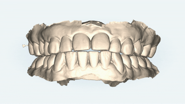 개방교합은 교정용 미니스크류 쓰지말고 인비절라인만으로 쉽게 해결하세요! (잠실인비절라인  잠실새내인비절라인  개방교합교정  잠실새내교정치과) 관련 이미지 3