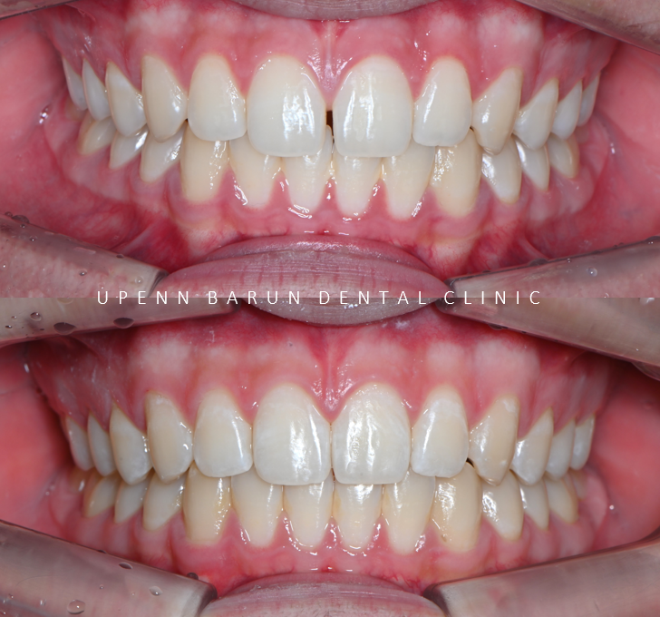 인비절라인다이아몬드등급치과에서 7주만에 앞니벌어짐 고민 해결한 후기(인비절라인앞니교정 인비절라인익스프레스 잠실인비절라인 인비절라인앞니교정후기) 관련 이미지 5