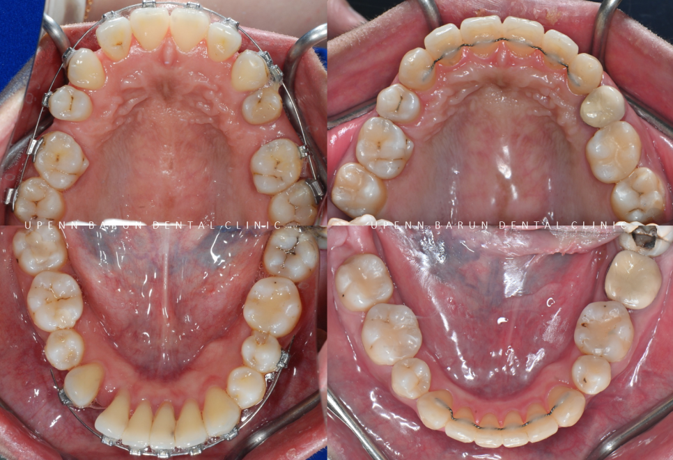 수술이 필요없는 잠실돌출입교정 잠실교정치과 입술이 잘 안다물어져 고민이라면? (돌출입전후 잠실새내교정치과 잠실발치교정 발치교정전후사진) 관련 이미지 11